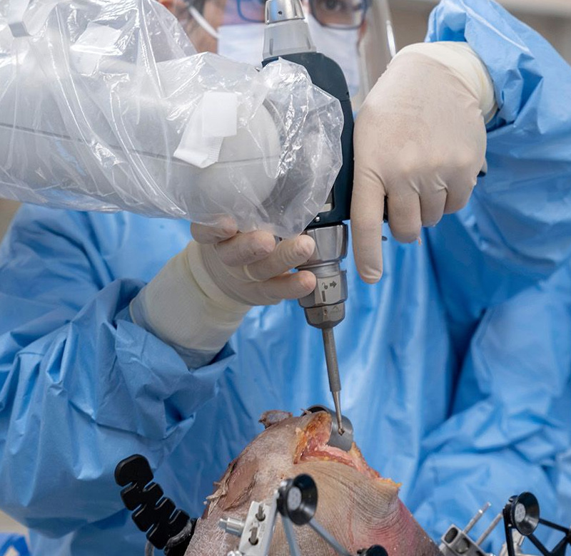 Robotic Knee Replacement Surgery 