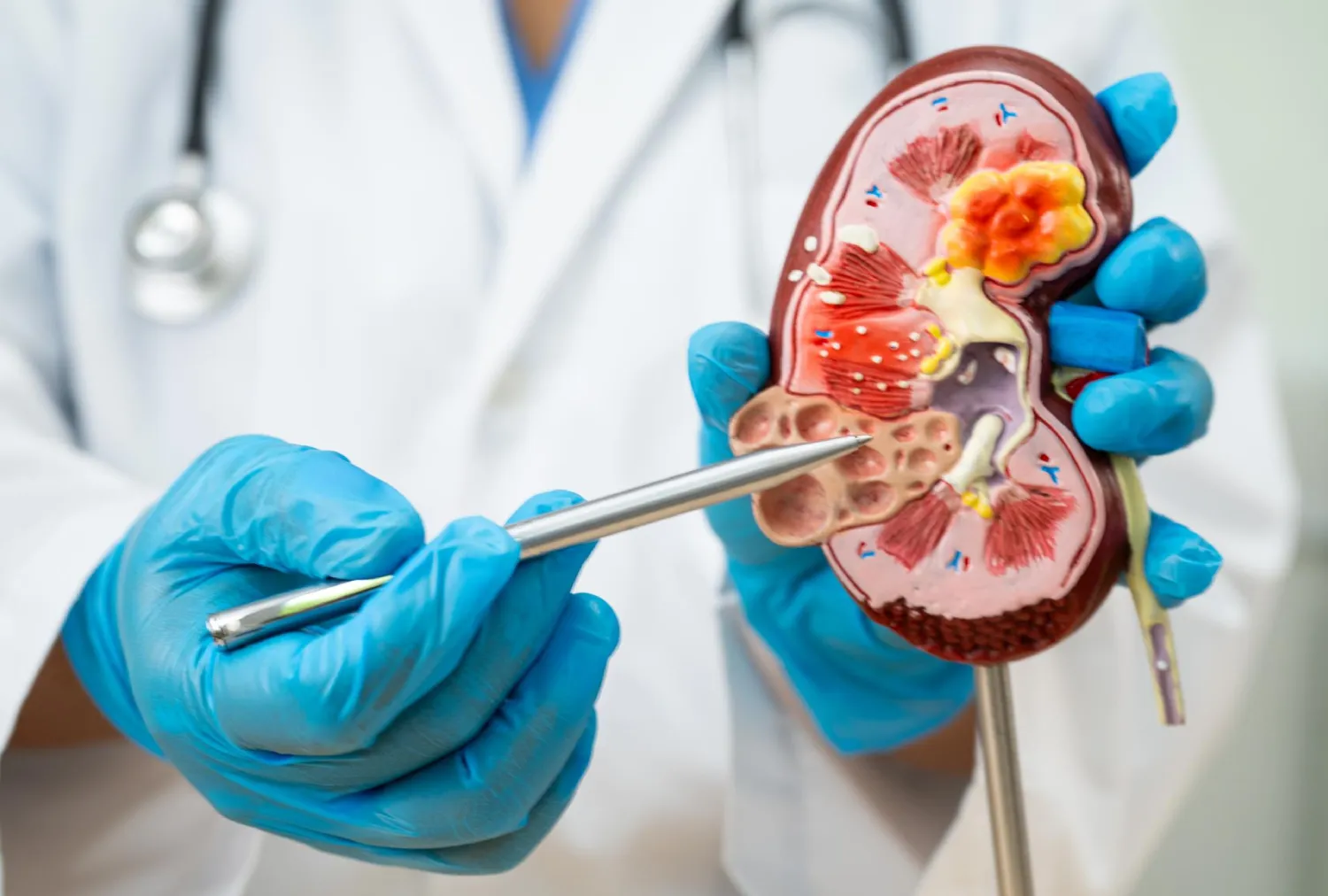 Blog Image - Understanding Chronic Kidney Disease: An Essential Guide to Early Symptoms and Advanced Nephrology Management