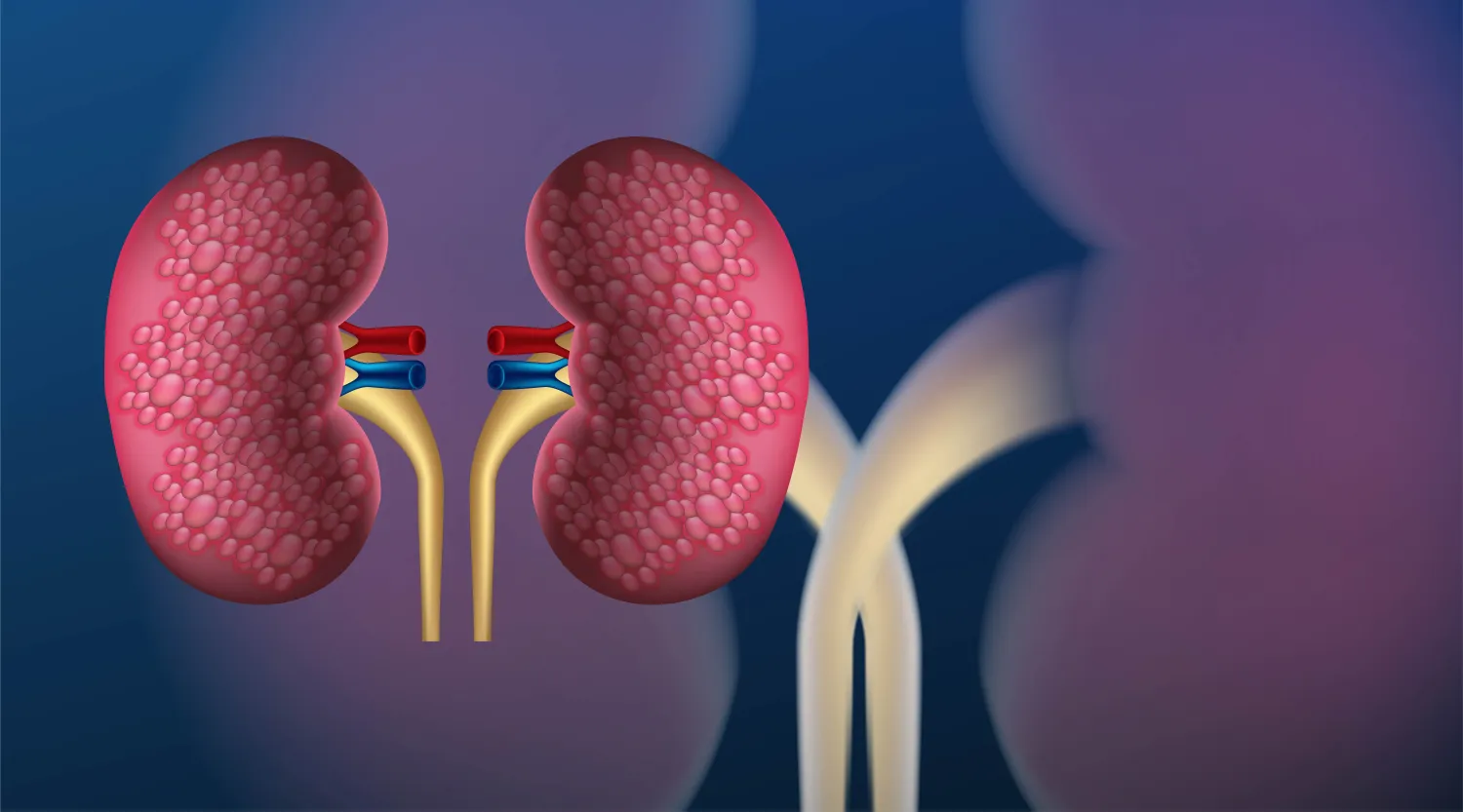 Blog Image - Chronic Kidney Disease (CKD): Symptoms, Causes and Treatment