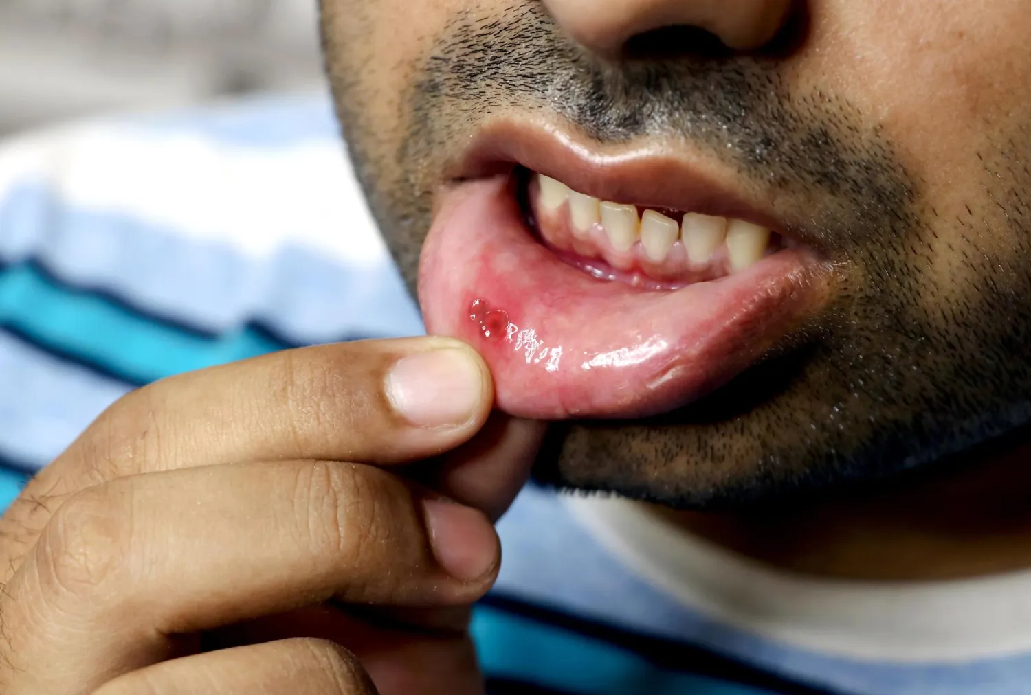 Blog Image - What Causes Mouth Ulcers and How to Treat Them Fast