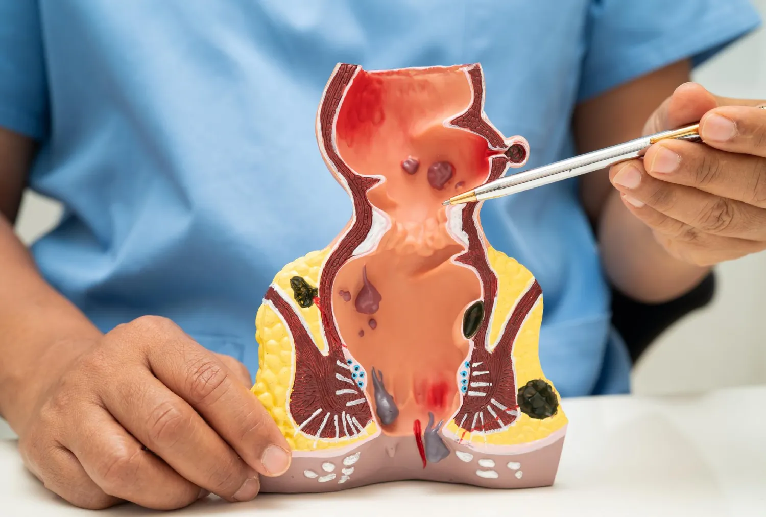 Blog Image - Piles vs Fissure vs Fistula: Differences Explained and When to See a Proctologist