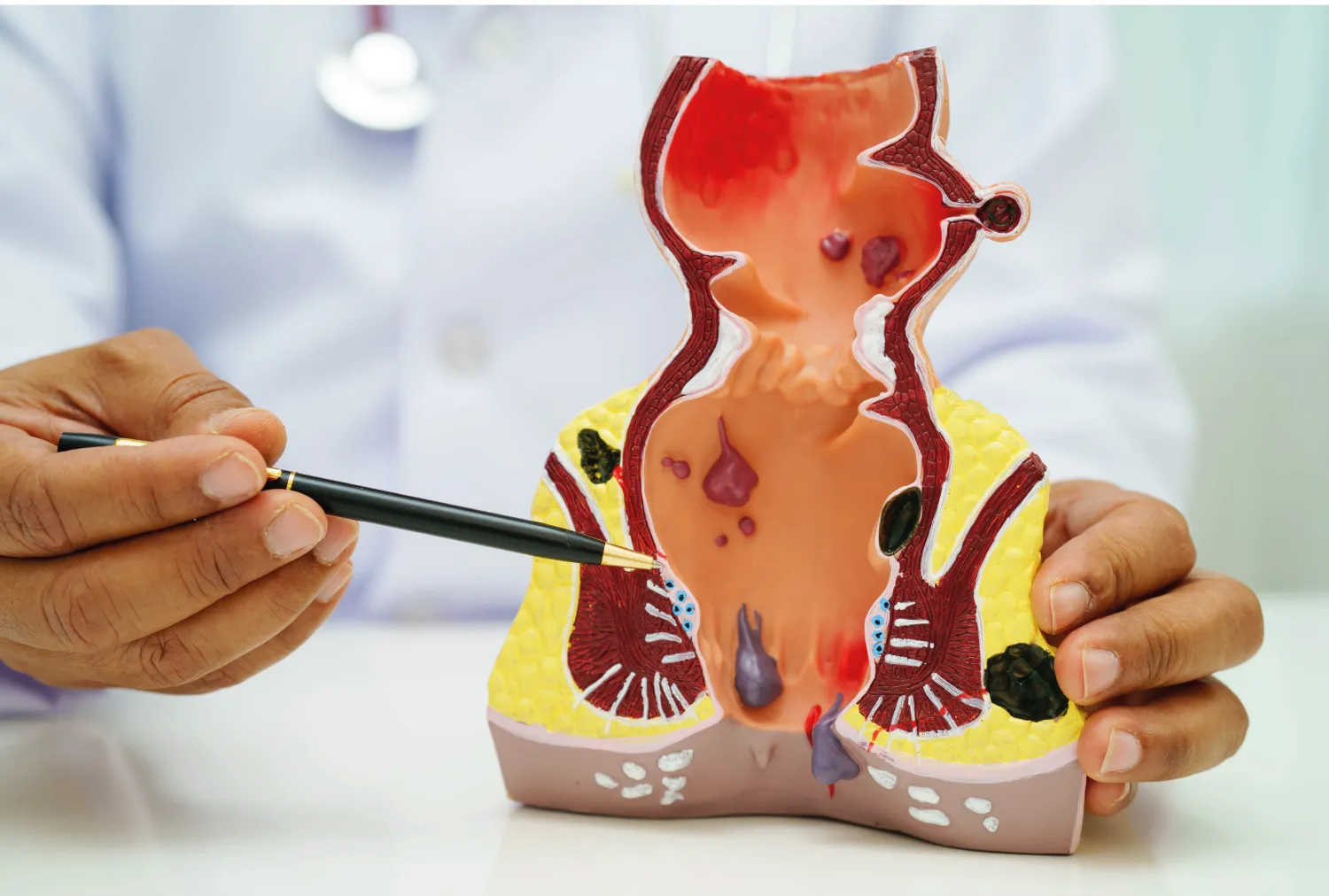Blog Image - Piles, Fissures, and Fistula — Understanding Anorectal Disorders