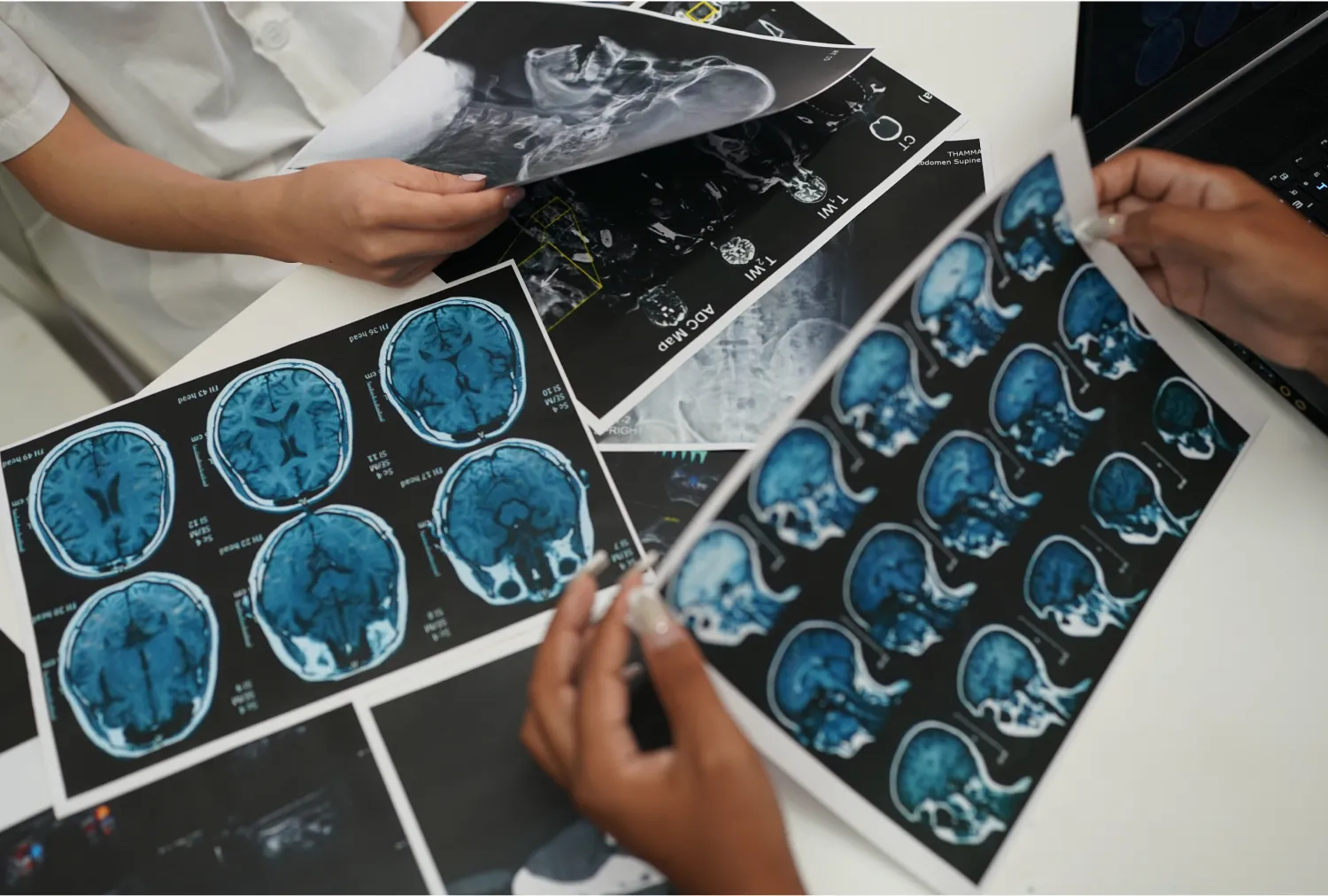 Blog Image - Brain Tumor: Symptoms, Diagnosis, and Treatment Options