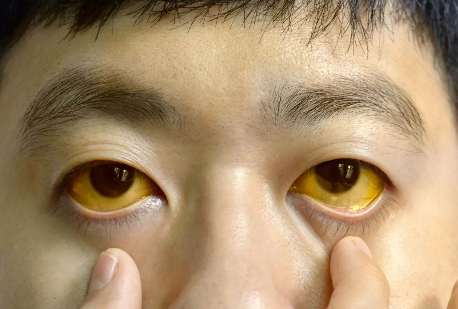 Blog Image - Jaundice in Adults: Causes, Symptoms, and When to Worry